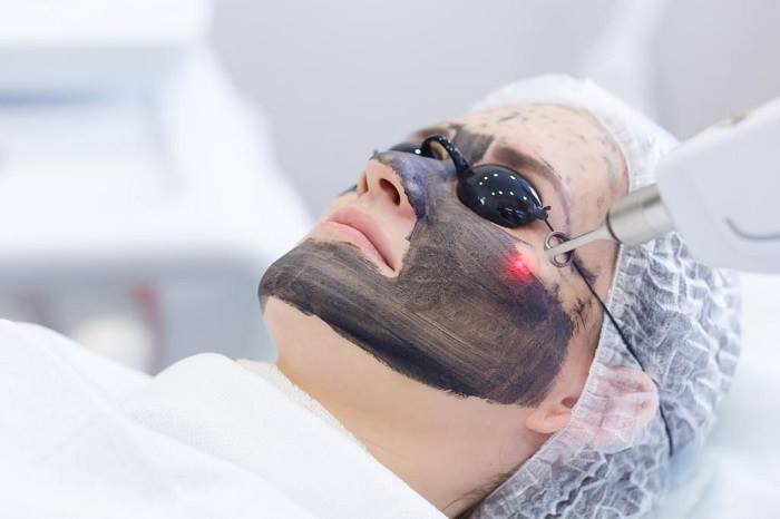 lieu-phap-laser-cacbon-trang-sang-da