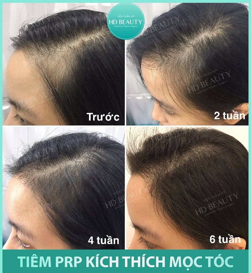Phuc-hoi-toc-voi-vien-tham-my-hd-beauty