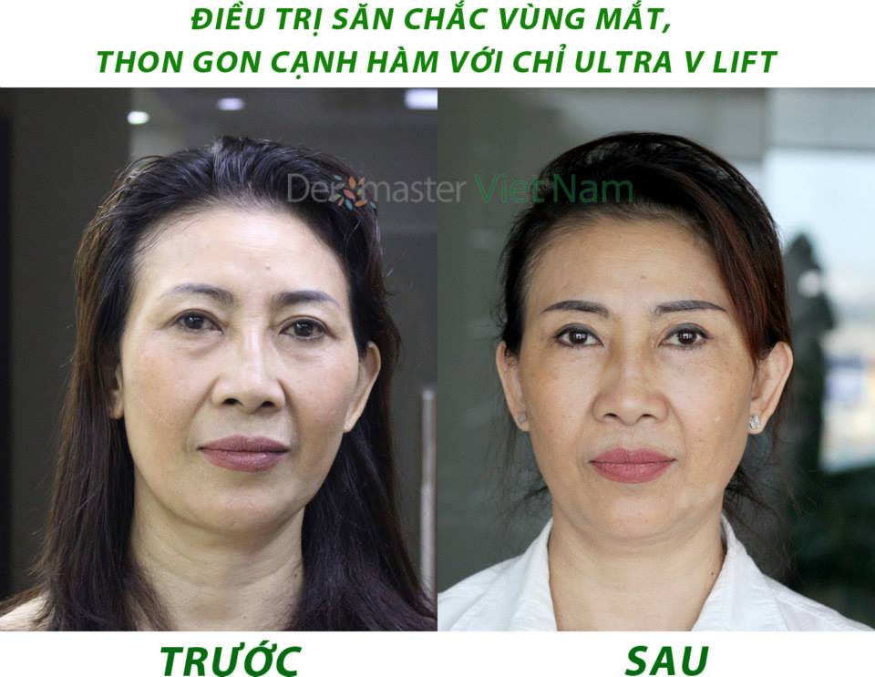 khach-hang-myspa-dermaster- viet- nam