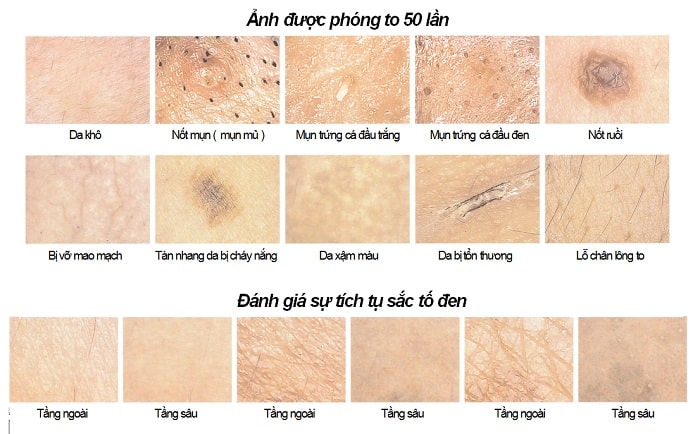 Một số vấn đề về da dưới máy soi