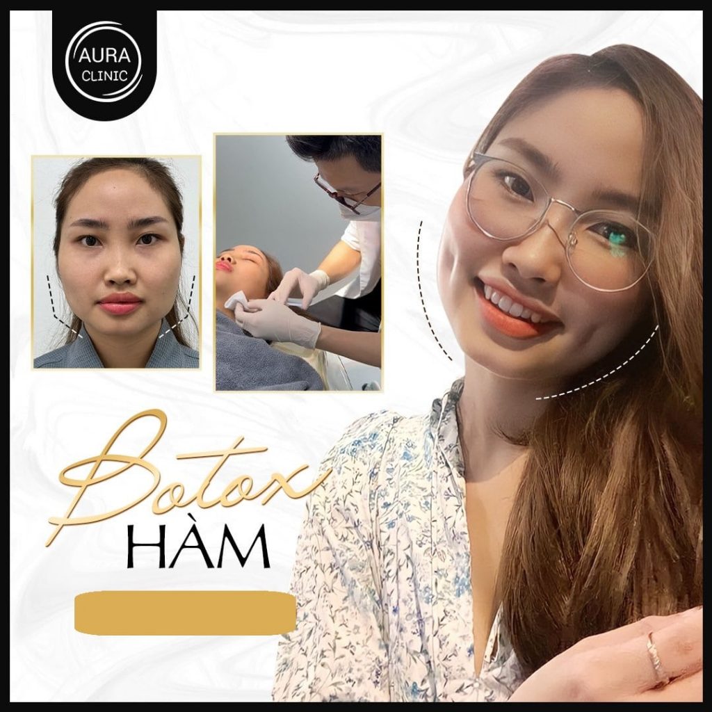 Tiêm botox thon gọn hàm