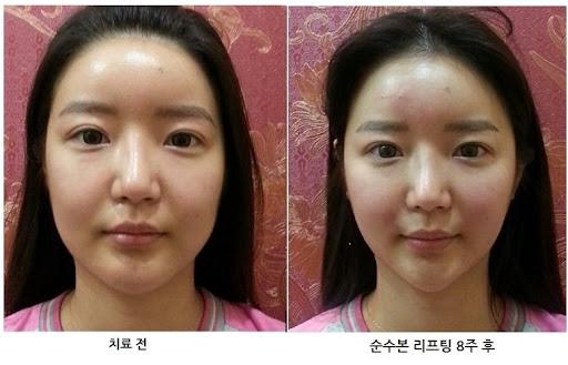 Ảnh minh họa hiệu quả của phương pháp Nâng cơ Beauty Energy Lifting
