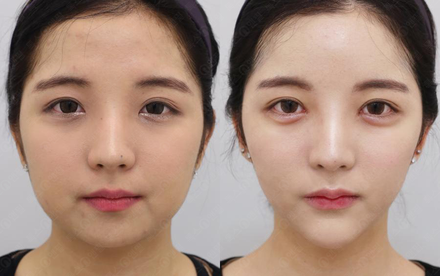 Ảnh minh họa hiệu quả của phương pháp Nâng cơ Beauty Energy Lifting