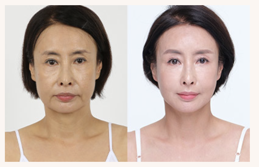Ảnh minh họa tác dụng của phương pháp Nâng cơ Biocell