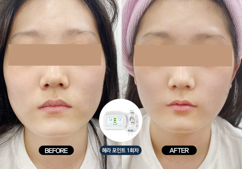 Ảnh minh họa hiệu quả của phương pháp Nâng cơ T-raser