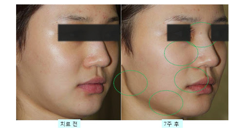 Ảnh minh họa hiệu quả của phương pháp Nâng cơ T-raser